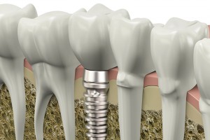 implant_img001